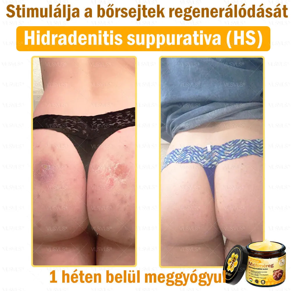 VLSVLS® Méhméreg Bőrhelyreállító Krém (👨⚕CE jóváhagyott)👍✅