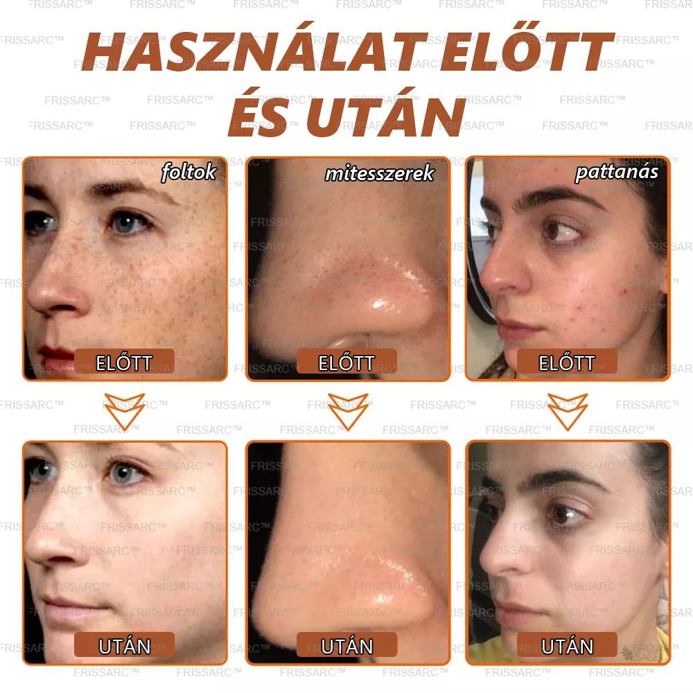 đFRISSARCâą fehĂ©rĂtĆ Ă©s folteltĂĄvolĂtĂł arcmaszk âđ©ââïžTermĂ©szetes összetevĆk tartĂłsan eltĂŒntetik a foltokat, szeplĆket Ă©s napfoltokat.