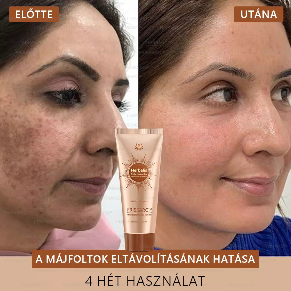 đFRISSARCâą fehĂ©rĂtĆ Ă©s folteltĂĄvolĂtĂł arcmaszk âđ©ââïžTermĂ©szetes összetevĆk tartĂłsan eltĂŒntetik a foltokat, szeplĆket Ă©s napfoltokat.