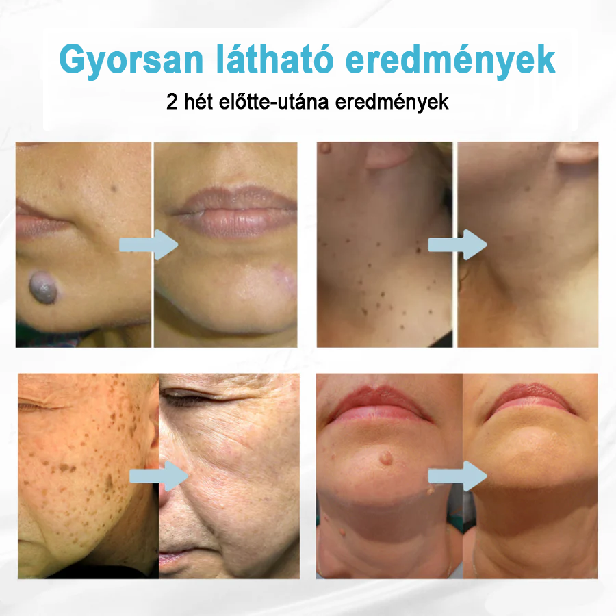 Bivora®✨ VelvetSkin+ – CO₂ lézeres toll a 🟤 anyajegyek, 🦠 szemölcsök, 🔘 pigmentfoltok és egyéb bőrhibák eltávolítására 🩹