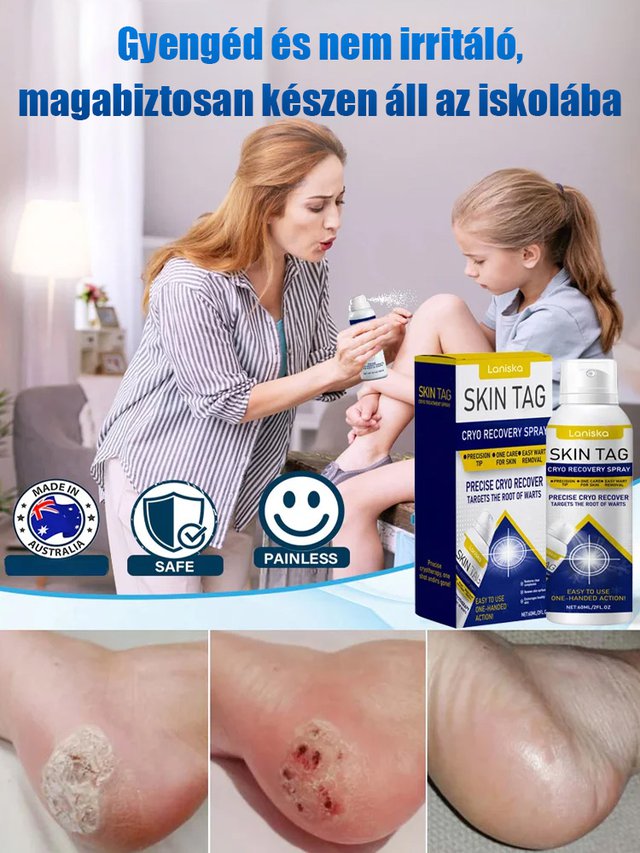 Bőrszemölcs külső ápoló permet Bőrszemölcs külső ápoló permet !!!Mondj búcsút a szemölcsöknek, légy magabiztos minden pillanatban!