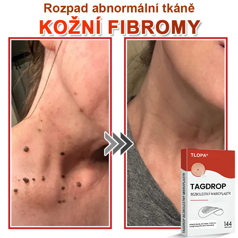 TLOPA® Mikrovpichová botanická náplast na odstranění kožních výrůstků 🇨🇿 Vyrobeno v Česká republika🇨🇿🇨🇿