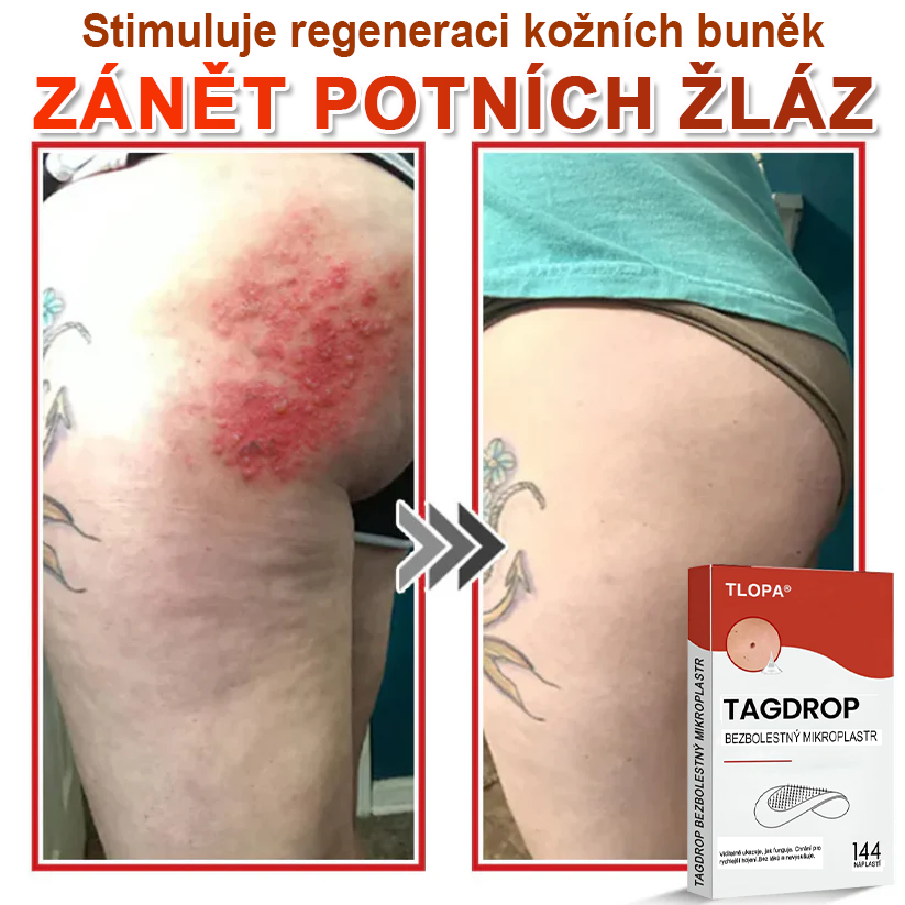 TLOPA® Mikrovpichová botanická náplast na odstranění kožních výrůstků 🇨🇿 Vyrobeno v Česká republika🇨🇿🇨🇿