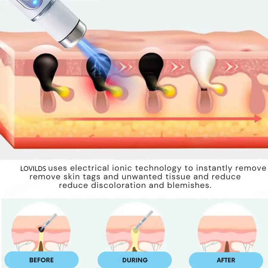 🔥【OFFICIAL STORE】LOVILDS™ Non-Invasive Mole and Wart Removal Laser Pen