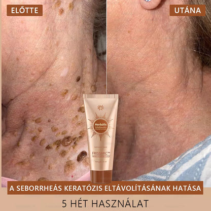 💟FRISSARC™ fehérítő és folteltávolító arcmaszk –👩‍⚕️Természetes összetevők tartósan eltüntetik a foltokat, szeplőket és napfoltokat.