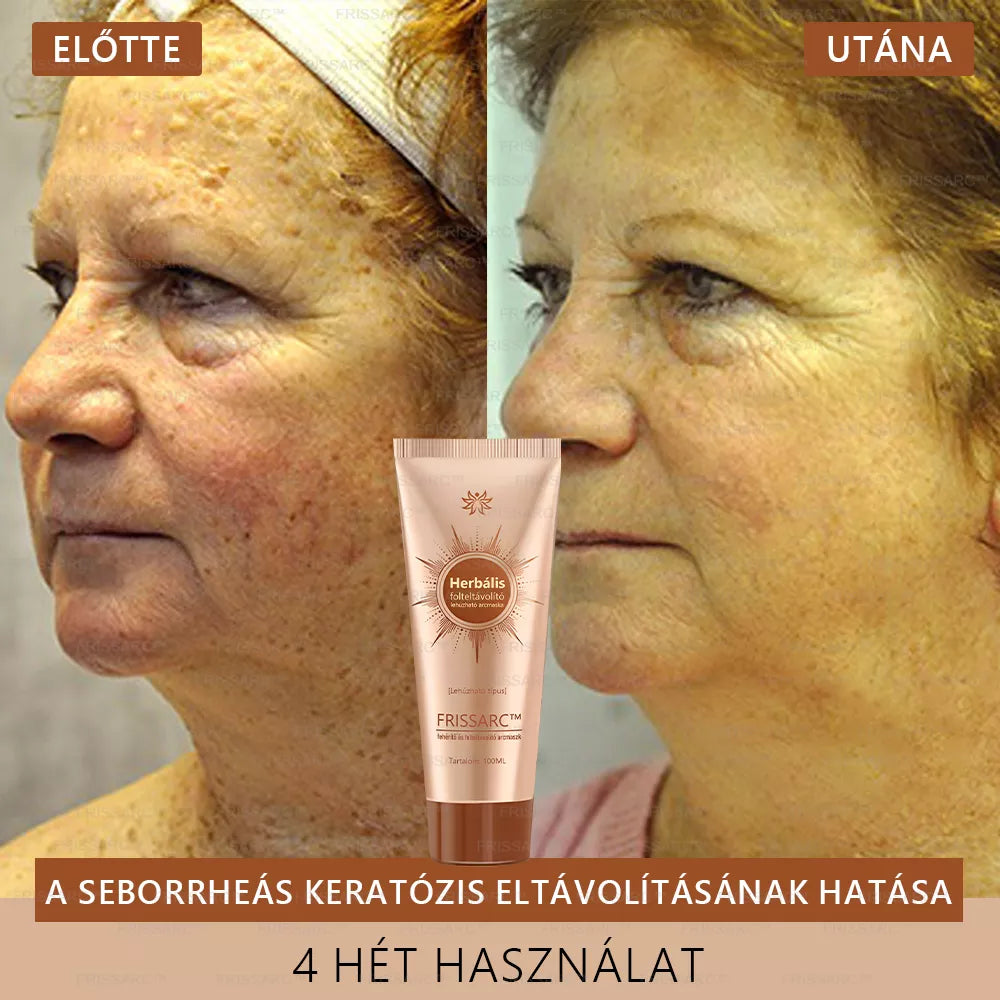 💟FRISSARC™ fehérítő és folteltávolító arcmaszk –👩‍⚕️Természetes összetevők tartósan eltüntetik a foltokat, szeplőket és napfoltokat.