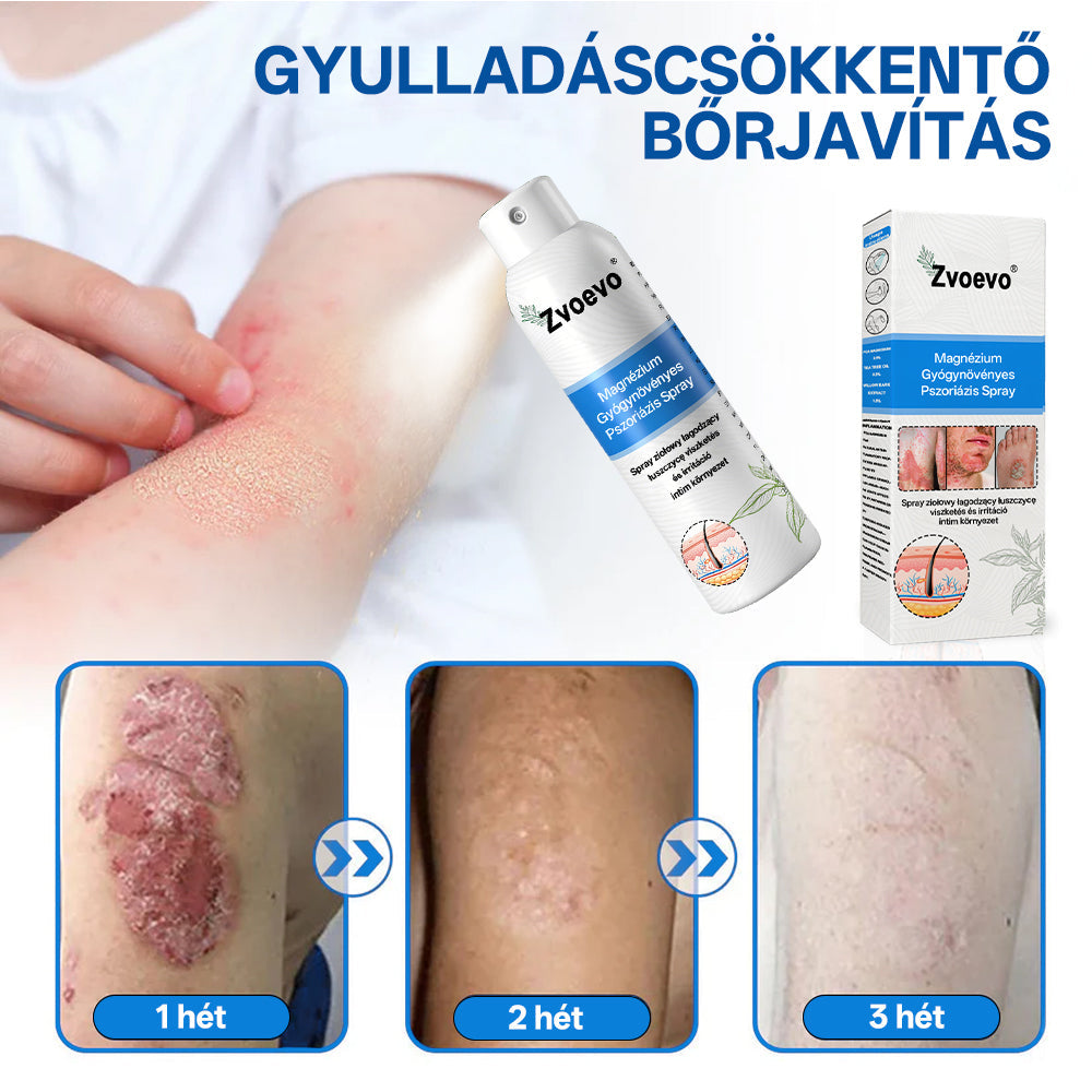 Zvoevo® Magnézium Gyógynövényes Pszoriázis Spray✨