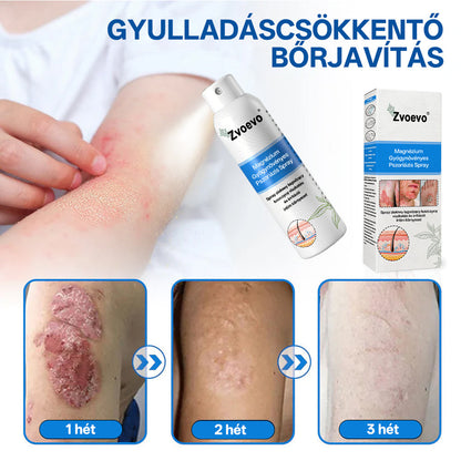 Zvoevo® Magnézium Gyógynövényes Pszoriázis Spray✨