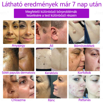 𝐉𝐚𝐬𝐬𝐞𝐞𝐦® Fejlett, nem invazív bőrjavító CO₂ lézeres toll 🎉 (Gyengéden eltávolítja a szemölcsöket, anyajegyeket, öregségi foltokat és bőrkinövéseket – fájdalom és gond nélkül!)