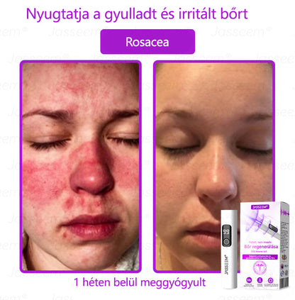 𝐉𝐚𝐬𝐬𝐞𝐞𝐦® Fejlett, nem invazív bőrjavító CO₂ lézeres toll 🎉 (Gyengéden eltávolítja a szemölcsöket, anyajegyeket, öregségi foltokat és bőrkinövéseket – fájdalom és gond nélkül!)