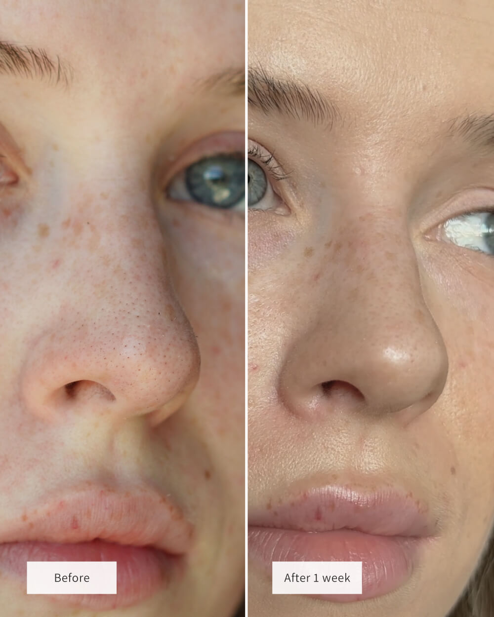 NOSE PATCHES | Made in Korea | Vegan & Cruelty free | Backed by Science