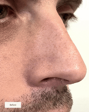 NOSE PATCHES | Made in Korea | Vegan & Cruelty free | Backed by Science