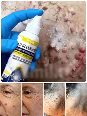 [Wart Removal Without Recurrence] Topical Skin Care Spray