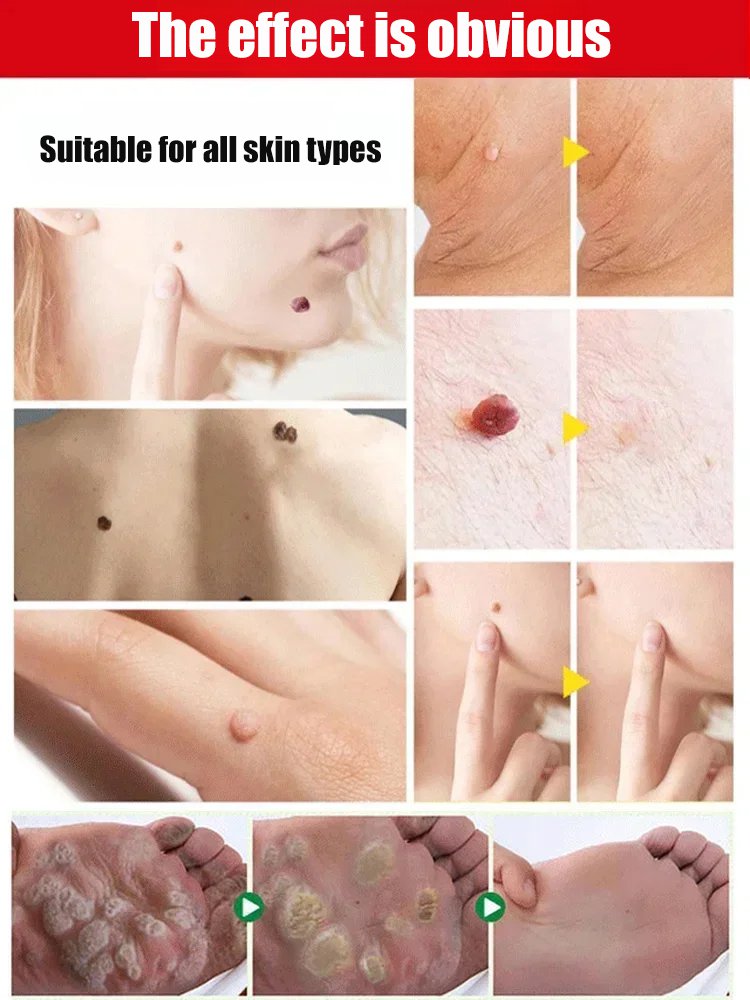 [Wart Removal Without Recurrence] Topical Skin Care Spray