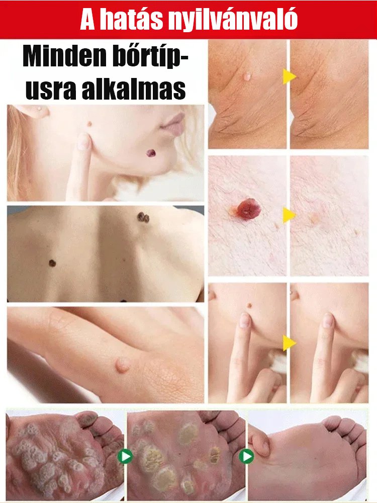 Bőrszemölcs külső ápoló permet Bőrszemölcs külső ápoló permet ！！！Mondj búcsút a szemölcsöknek, légy magabiztos minden pillanatban!