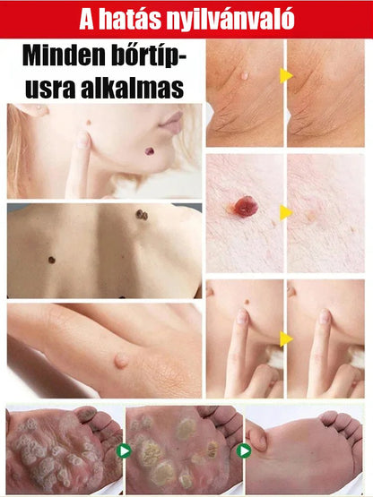 Bőrszemölcs külső ápoló permet Bőrszemölcs külső ápoló permet ！！！Mondj búcsút a szemölcsöknek, légy magabiztos minden pillanatban!