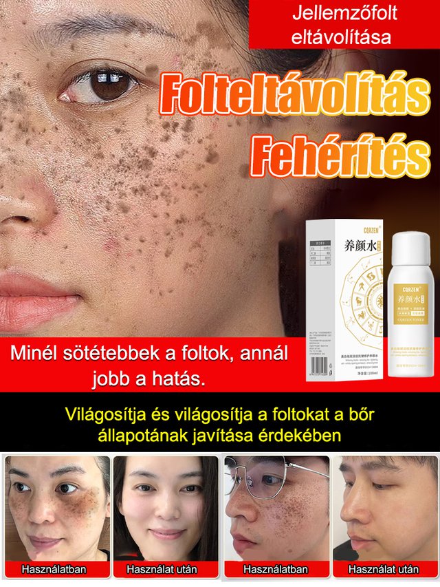 【Arcfoltok eltávolítása】Folteltávolító permet - Egy spray az arc foltjainak eltávolítására, szuper hatékony!!