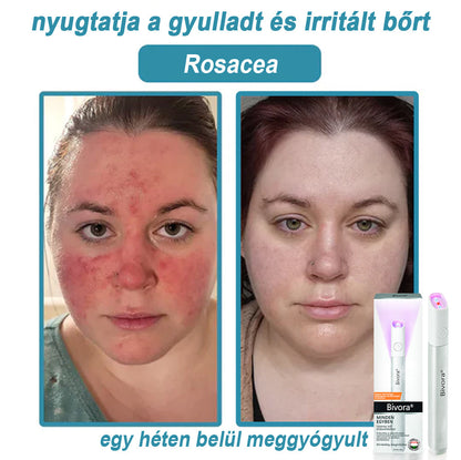 Bivora®✨ VelvetSkin+ – CO₂ lézeres toll a 🟤 anyajegyek, 🦠 szemölcsök, 🔘 pigmentfoltok és egyéb bőrhibák eltávolítására 🩹