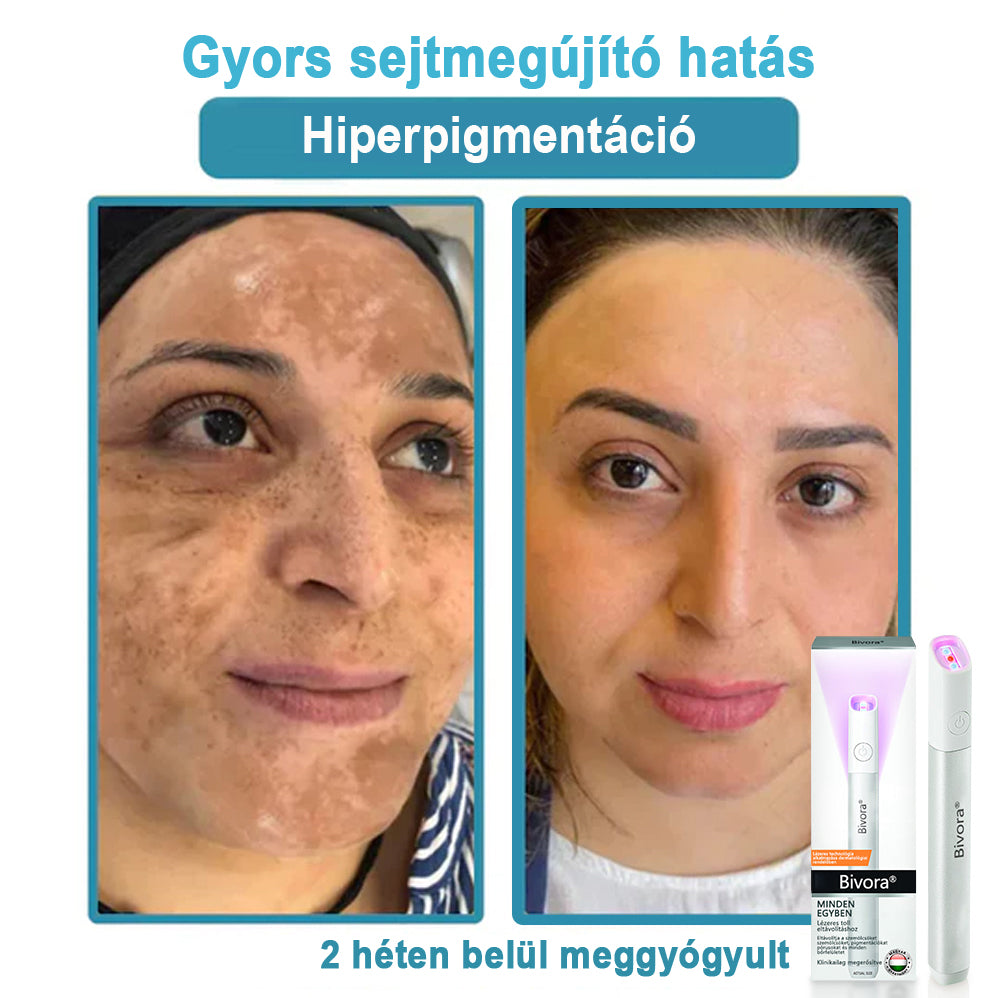 Bivora®✨ VelvetSkin+ – CO₂ lézeres toll a 🟤 anyajegyek, 🦠 szemölcsök, 🔘 pigmentfoltok és egyéb bőrhibák eltávolítására 🩹
