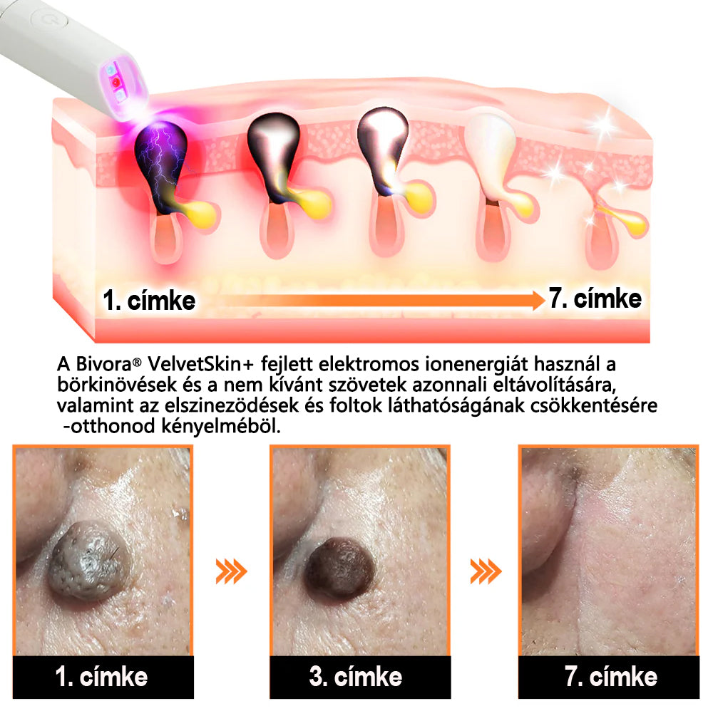 Bivora®✨ VelvetSkin+ – CO₂ lézeres toll a 🟤 anyajegyek, 🦠 szemölcsök, 🔘 pigmentfoltok és egyéb bőrhibák eltávolítására 🩹