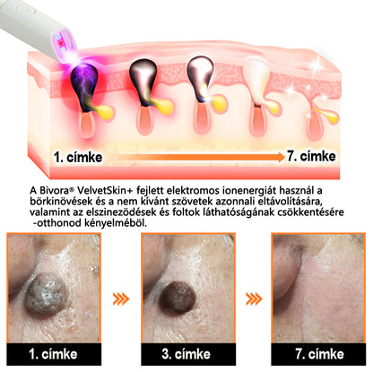 Bivora®✨ VelvetSkin+ – CO₂ lézeres toll a 🟤 anyajegyek, 🦠 szemölcsök, 🔘 pigmentfoltok és egyéb bőrhibák eltávolítására 🩹