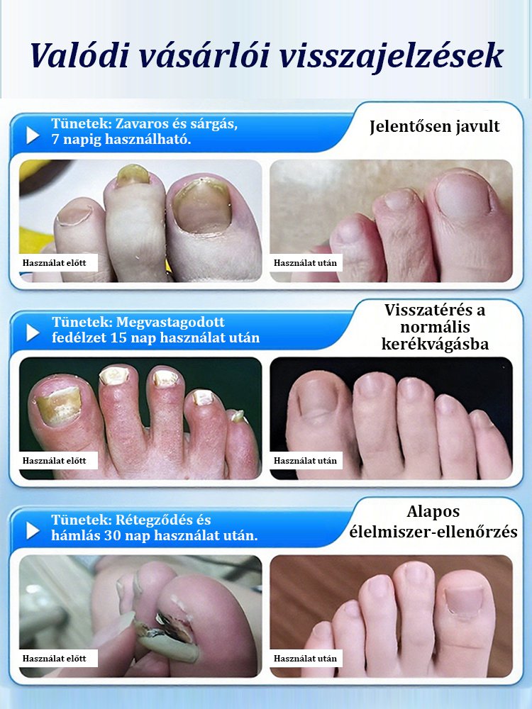 【3 nap fájdalommentes új köröm】Vastagító és fényesítő ápoló folyadék gombás körömre