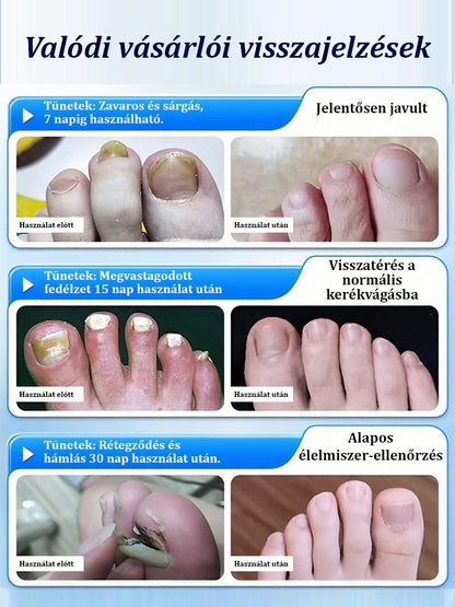 【3 nap fájdalommentes új köröm】Vastagító és fényesítő ápoló folyadék gombás körömre