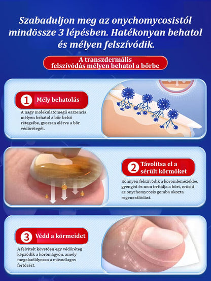 【3 nap fájdalommentes új köröm】Vastagító és fényesítő ápoló folyadék gombás körömre