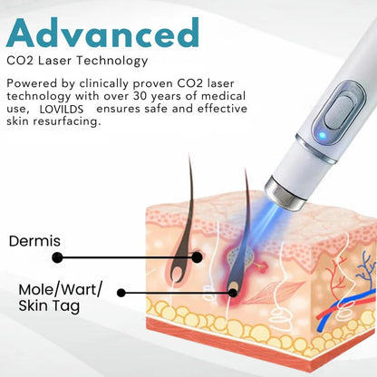 🔥【OFFICIAL STORE】LOVILDS™ Non-Invasive Mole and Wart Removal Laser Pen